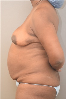 Tummy Tuck Before Photo by Keshav Magge, MD; Bethesda, MD - Case 41777