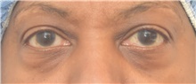 Eyelid Surgery Before Photo by Keshav Magge, MD; Bethesda, MD - Case 41948