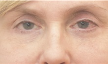 Eyelid Surgery After Photo by Keshav Magge, MD; Bethesda, MD - Case 41950