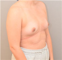 Breast Augmentation Before Photo by Keshav Magge, MD; Bethesda, MD - Case 42033