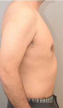 Male Breast Reduction After Photo by Keshav Magge, MD; Bethesda, MD - Case 42068