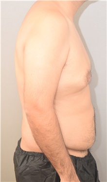 Male Breast Reduction Before Photo by Keshav Magge, MD; Bethesda, MD - Case 42068