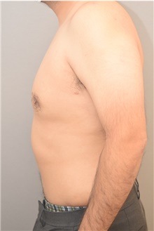 Male Breast Reduction After Photo by Keshav Magge, MD; Bethesda, MD - Case 42068