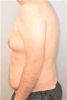 Male Breast Reduction Before Photo by Keshav Magge, MD; Bethesda, MD - Case 42068
