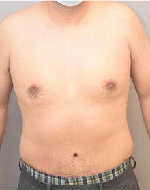 Tummy Tuck After Photo by Keshav Magge, MD; Bethesda, MD - Case 42069