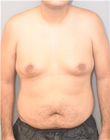 Tummy Tuck Before Photo by Keshav Magge, MD; Bethesda, MD - Case 42069