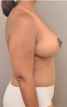 Breast Lift After Photo by Keshav Magge, MD; Bethesda, MD - Case 42647