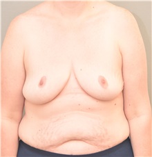 Breast Augmentation Before Photo by Keshav Magge, MD; Bethesda, MD - Case 42650