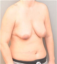 Breast Lift Before Photo by Keshav Magge, MD; Bethesda, MD - Case 42726