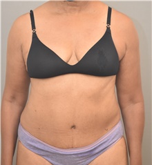Tummy Tuck After Photo by Keshav Magge, MD; Bethesda, MD - Case 42727