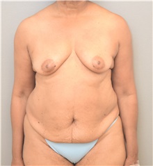 Tummy Tuck Before Photo by Keshav Magge, MD; Bethesda, MD - Case 42727