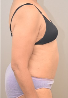 Tummy Tuck After Photo by Keshav Magge, MD; Bethesda, MD - Case 42727