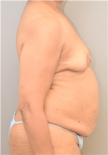 Tummy Tuck Before Photo by Keshav Magge, MD; Bethesda, MD - Case 42727