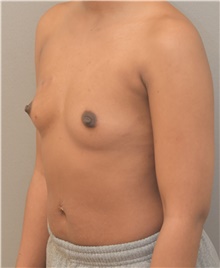 Breast Augmentation Before Photo by Keshav Magge, MD; Bethesda, MD - Case 42729