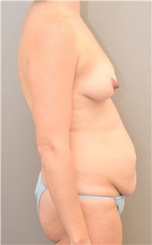 Tummy Tuck Before Photo by Keshav Magge, MD; Bethesda, MD - Case 42731