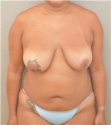Tummy Tuck Before Photo by Keshav Magge, MD; Bethesda, MD - Case 44528