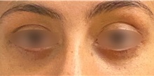 Eyelid Surgery After Photo by Keshav Magge, MD; Bethesda, MD - Case 44531