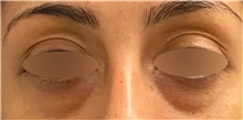 Eyelid Surgery Before Photo by Keshav Magge, MD; Bethesda, MD - Case 44531