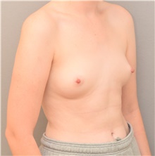 Breast Augmentation Before Photo by Keshav Magge, MD; Bethesda, MD - Case 44537