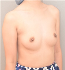 Breast Augmentation Before Photo by Keshav Magge, MD; Bethesda, MD - Case 44549