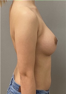 Breast Augmentation After Photo by Keshav Magge, MD; Bethesda, MD - Case 44549