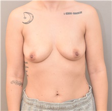 Breast Augmentation Before Photo by Keshav Magge, MD; Bethesda, MD - Case 44652