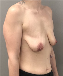 Breast Lift Before Photo by Keshav Magge, MD; Bethesda, MD - Case 44653