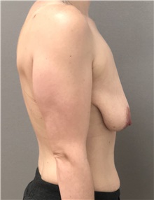 Breast Lift Before Photo by Keshav Magge, MD; Bethesda, MD - Case 44653