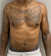 Male Breast Reduction After Photo by Keshav Magge, MD; Bethesda, MD - Case 44689