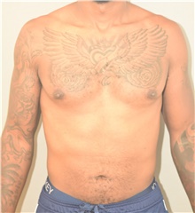 Male Breast Reduction Before Photo by Keshav Magge, MD; Bethesda, MD - Case 44689