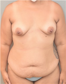 Tummy Tuck Before Photo by Keshav Magge, MD; Bethesda, MD - Case 44698