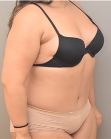 Tummy Tuck After Photo by Keshav Magge, MD; Bethesda, MD - Case 44698