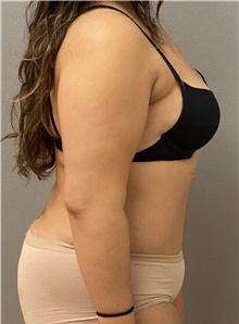 Tummy Tuck After Photo by Keshav Magge, MD; Bethesda, MD - Case 44698