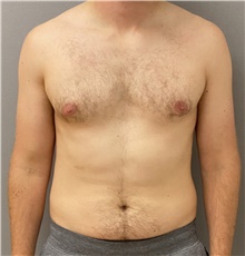 Male Breast Reduction Before Photo by Keshav Magge, MD; Bethesda, MD - Case 44703