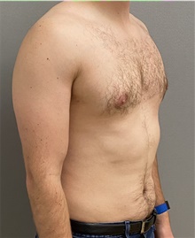 Male Breast Reduction After Photo by Keshav Magge, MD; Bethesda, MD - Case 44703