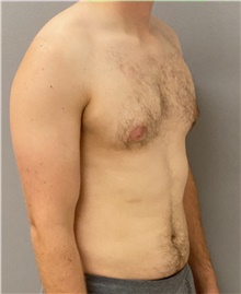 Male Breast Reduction Before Photo by Keshav Magge, MD; Bethesda, MD - Case 44703