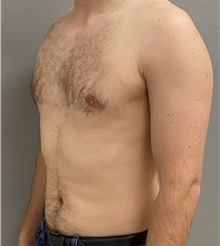 Male Breast Reduction After Photo by Keshav Magge, MD; Bethesda, MD - Case 44703