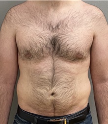 Male Breast Reduction After Photo by Keshav Magge, MD; Bethesda, MD - Case 44704