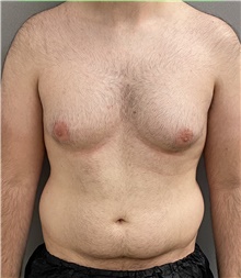 Male Breast Reduction Before Photo by Keshav Magge, MD; Bethesda, MD - Case 44704