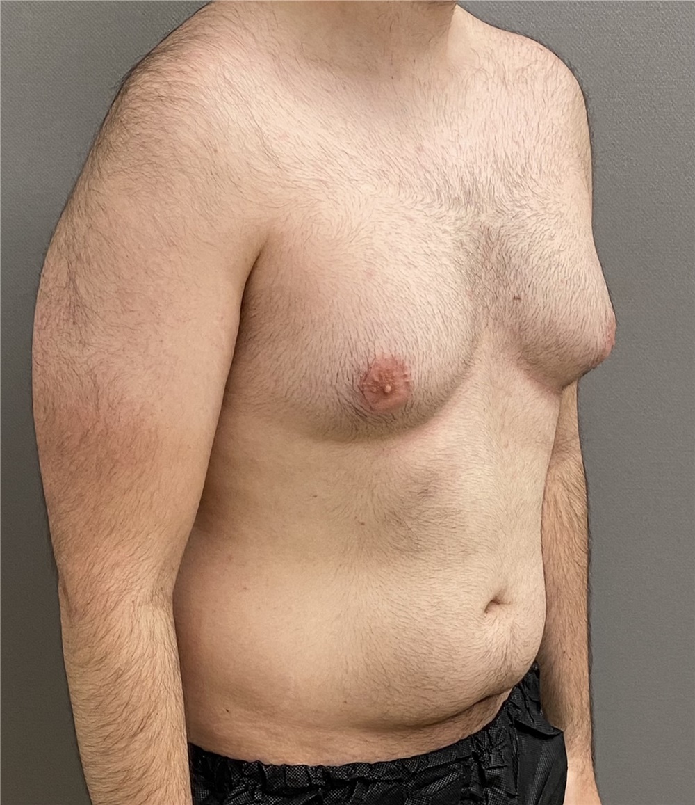 Male Breast Reduction Before and After Photos by Keshav Magge, MD; Bethesda,  MD - Case 44704