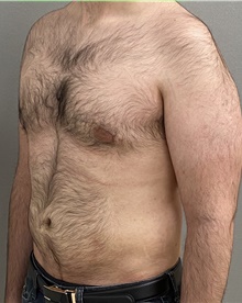 Liposuction After Photo by Keshav Magge, MD; Bethesda, MD - Case 44705