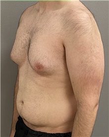Liposuction Before Photo by Keshav Magge, MD; Bethesda, MD - Case 44705