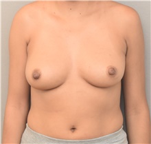 Breast Augmentation Before Photo by Keshav Magge, MD; Bethesda, MD - Case 44719