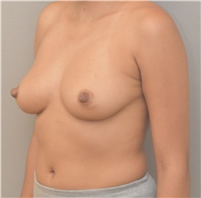 Breast Augmentation Before Photo by Keshav Magge, MD; Bethesda, MD - Case 44719
