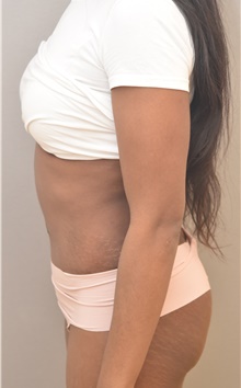 Tummy Tuck After Photo by Keshav Magge, MD; Bethesda, MD - Case 44720