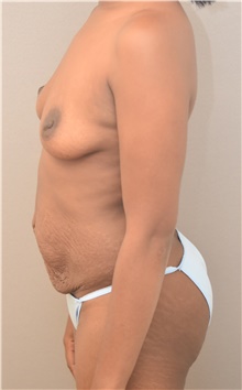 Tummy Tuck Before Photo by Keshav Magge, MD; Bethesda, MD - Case 44720