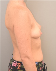 Breast Augmentation Before Photo by Keshav Magge, MD; Bethesda, MD - Case 44723