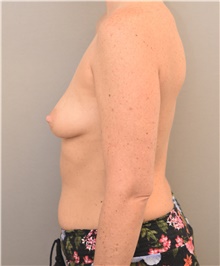 Tummy Tuck Before Photo by Keshav Magge, MD; Bethesda, MD - Case 44724