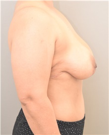 Breast Lift Before Photo by Keshav Magge, MD; Bethesda, MD - Case 44734