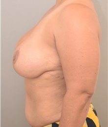 Breast Lift After Photo by Keshav Magge, MD; Bethesda, MD - Case 44734